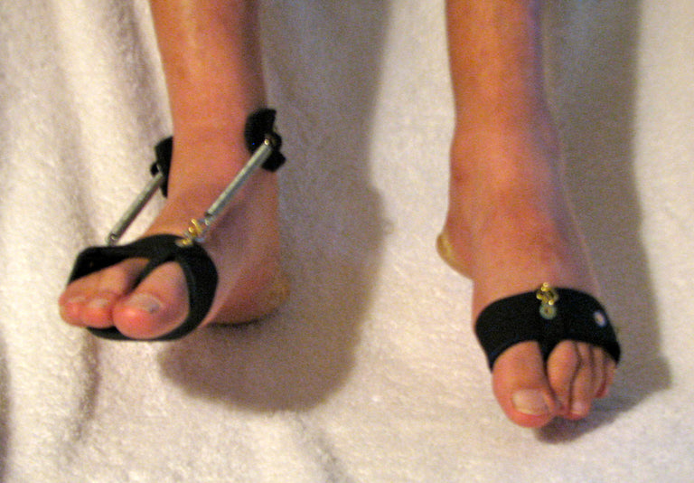 showing how the Freedom Walk AFO's Free Flex Drop Foot Brace and BareFoot Accessory (BFA) provides proper support to the foot compared to a foot without the brace